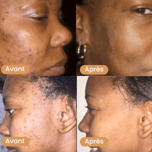 Avant_apres_savon_au_curcuma_2 - Prestiglow™