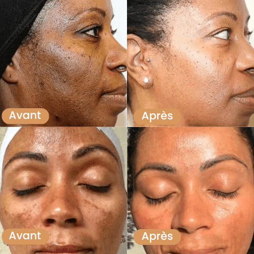 Savon Anti tache brune au Curcuma - Prestiglow™