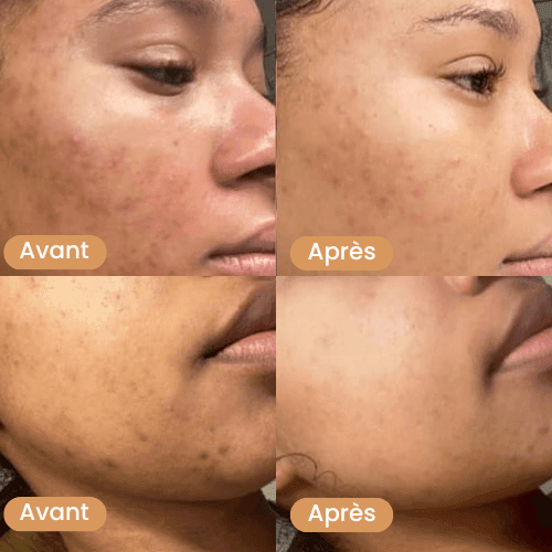 Coton Réducteur d'Imperfections à l’acide kojique & curcuma - Prestiglow™